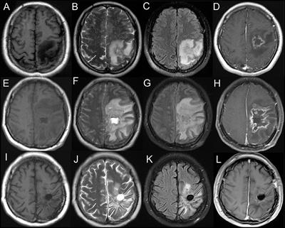 Primary Angiitis of the Central Nervous System Mimicking Glioblastoma: A Case Report and Literature Review